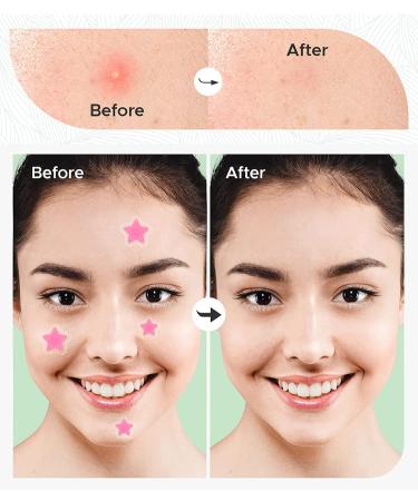 Shop Cute Star Acne Patches - Hydrocolloid Pimple Dots for Blemish Control | 36pc Pack - Fashionable Skin Care Treatment - Buy Online on GoSupps.com