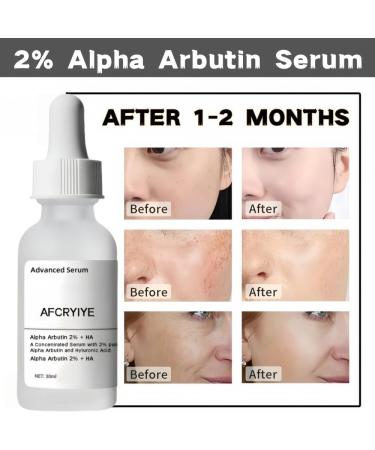 2% Alpha Arbutin + Hyaluronic Acid Facial Serum - Brightening Serum for Dark Spots Fade Acne Scars & Pigmentation - Helps Reduce The Appearance of Melasma & Blemishes - 1 Fl Oz (2PC) - Buy Online on GoSupps.com
