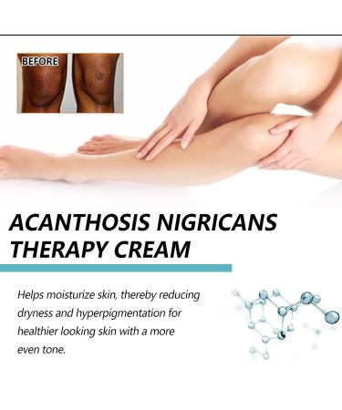 2Pcs Advanced Acanthosis Nigricans Treatment Body Cream - Dark Neck Cream for Damaged Skin - Exfoliating Therapy Oil - Buy Online on GoSupps.com