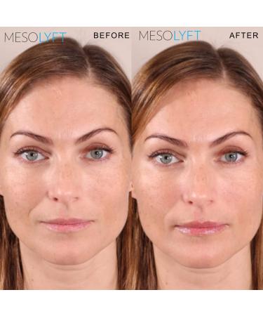 Lip Plumper with Roller to Instantly Plump Lips Promotes Hydration and Fullness Plumping Lip Gloss for Fuller Lips Serum to Moisturize Your Lips (12 ML) 12 Fl Oz (Pack of 1) - Buy Online on GoSupps.com