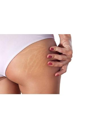 POSTQUAM Professional Slim Code Stretch Marks Solution 200ml /6.8oz Nourishes And Firms The Skin For Stretch Marks and Hydrates The Skin - Natural And Active Ingredients - Buy Online on GoSupps.com