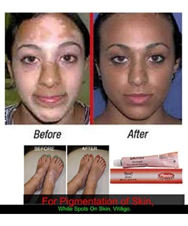 Bhandari Skinto Ointment 15g - For Pigmentation & White Spots on Skin - Buy Online on GoSupps.com