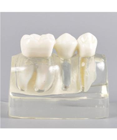 Dental Model Dentist Dental implant Model Resin Material Removable Used for Dental Clinic Research and Doctor-Patient Communication - Buy Online on GoSupps.com
