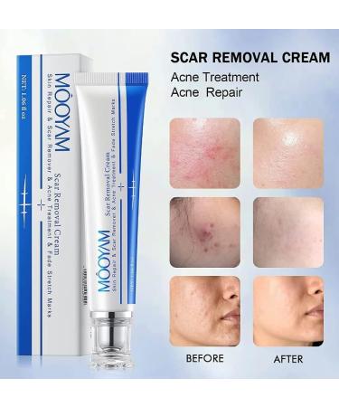 Harsha Tamoskiny Scar Removal Cream 30g - for Stretch Marks, Surgery, Injuries & Burns - All Skin Types - Buy Online on GoSupps.com