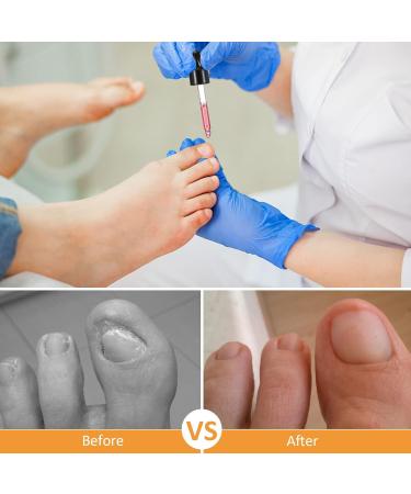 Ingrown Toenail Treatment - Ingrown Toenail Pain Reliever and Softener Kit for Easy Trimming with Silicone Gel Toe Caps Clear - Buy Online on GoSupps.com
