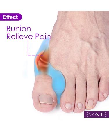 Smati Bunion Correctors 4PCS - Light Blue Toe Straightener & Protector for Hallux Valgus Pain Relief - Buy Online on GoSupps.com