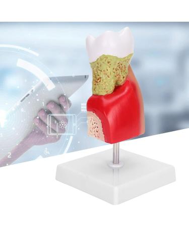 Verdant Touch Tooth Model - Dental Caries Teaching & Training Aid for Patient Education - International Shipping - Buy Online on GoSupps.com