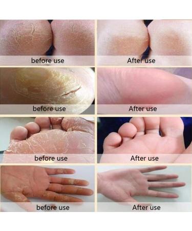 MRB Foot Care Cream - Repair Very Dry Feet & Cracked Heels | 55g Moisturizing Solution for Healthy Feet - Buy Online on GoSupps.com