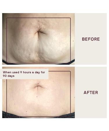 Buy Dermaclara Silicone Stretch Marks Patch Kit - Effective One Patch Solution for Scars | International Shipping Available - Buy Online on GoSupps.com