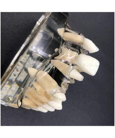 Implant Tooth Template | Oral Simulation Dental Study Model for Teaching - Shop Internationally - Buy Online on GoSupps.com