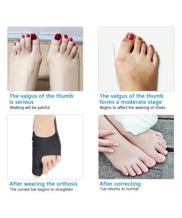 Hallux Valgus Corrector & Ultra Toe Separator - Orthopedic Bunion Relief for Foot Pain - Adjustable Toe Separator for Day Use (L) - Buy Online on GoSupps.com