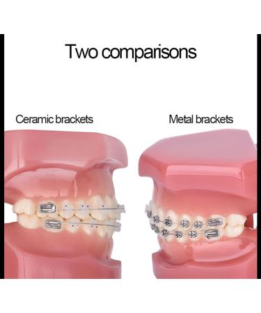 Dental Model Dentist Orthodontic Teeth Demonstration Model Orthodontic Dental Model with Ceramic Brackets and Metal Bracket for Learning Teaching Research - Buy Online on GoSupps.com