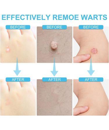 Skin Tag and Mole Removal Lotion - Fast-Acting Natural Remover for Warts - Easy Home Treatment (2PCS 40ML) - Buy Online on GoSupps.com
