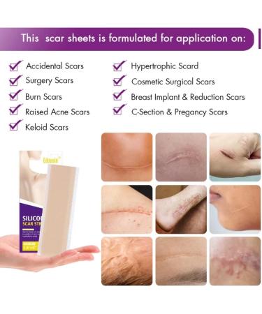 Silicone Scar Sheets 4 PCS Scar Removal Silicone Gel Scar Tape Effective Scar Treatment for Surgical Scars C-Section Deep Stretch Mark Removal Keloid Bump Removal Purple - Buy Online on GoSupps.com