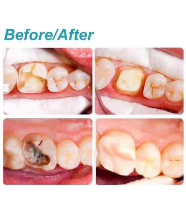Broken Tooth Repair Kit - Temporary Teeth Replacement for Missing Fillings & Gaps | Improve Your Smile - Buy Online on GoSupps.com