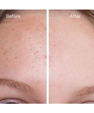 2.5% crystal-encapsulated Retinol serum works 11 times FASTER than cheap retinol. With 11% Hyaluronic Acid 20% Vitamin C & E Aloe Vera. Target fine lines wrinkles blemishes & acne scars. 30ml 2 Bottles - Buy Online on GoSupps.com