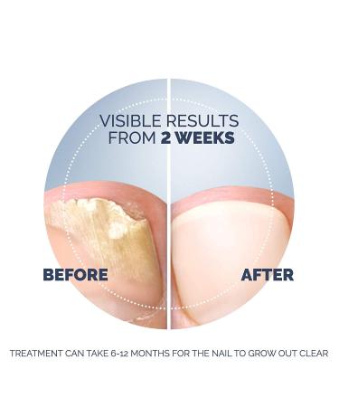 Scholl Fungal Nail Treatment 3.8ml - Effective Nail Fungus Remedy - Buy Online on GoSupps.com