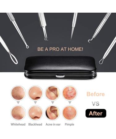 Antonki Blackhead Remover Tools Blackhead Extractor 6 Pack Pimple Popper Tool Kit for Blackhead Whitehead Acne Zit Comdone Pores Fat Granules Blemishs on Nose Face - with Organized Case - Buy Online on GoSupps.com