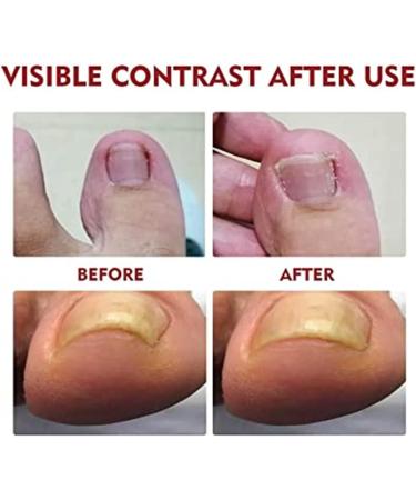 German Toenailcare Removal Paronychia Oil Care Oil for Removing Paronychia Toenail Treatment Best Nail Repair Solution Nail Renewal Liquid for Damaged & Discoloration Nail (3pcs) - Buy Online on GoSupps.com