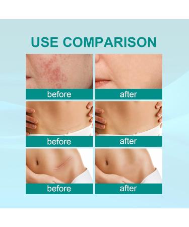 20g Medical Grade Scar Spray - Effective Scar Removal Treatment for All Scars (2Pcs) | International Shipping - Buy Online on GoSupps.com