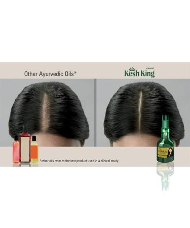 Emami Kesh King Ayurvedic Hair Growth Capsules (4 Boxes) + 100ml Hair Oil - Buy Online on GoSupps.com