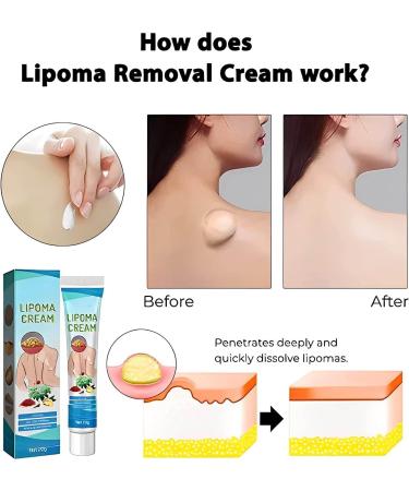Lipoma Removal Cream Cr me d' limination de lipomes Cellulite Removal Exfoliating Cream Get Rid of Your Fatty Lipoma Lumps (2pcs) - Buy Online on GoSupps.com
