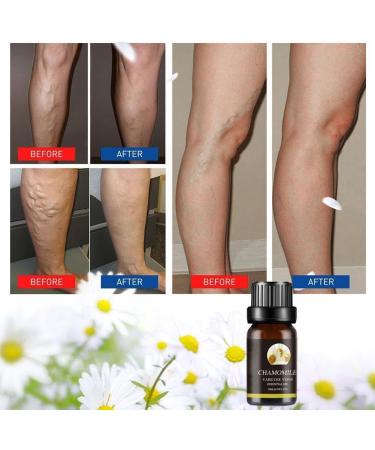 GXFCAI Marrony Oil for Varicose Veins | Effective Vein Treatment Spray for Legs | 10ml - 3 Boxes - Buy Online on GoSupps.com