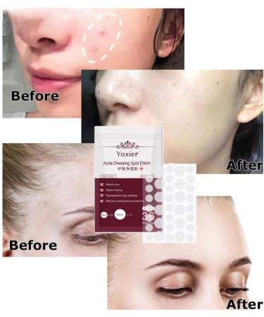 Acne Dressing Spot Patch Acne Paste Transparent Pimple Patch Breathable Painless Acne Treatment Gel Patch Skin Care Absorb Pus Rapid Healing Effective Antibacterial Protection 36 Patches - Buy Online on GoSupps.com