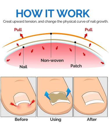 Ingrown Toenail Treatment - Painless Corrector Patch Strips with Nail Correction Tools | 50 Patches, Blue - Buy Online on GoSupps.com