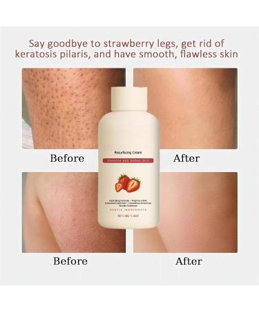 2Pcs strawberry Skin Treatment trawberry Legs Treatment Advanced Triple-Acid Complex Trystrawberry Resurfacing Cream Helps Reduce Chicken Skin Bumps Exfoliating Body Cream With Deep Hydration - Buy Online on GoSupps.com