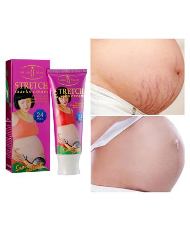 AICHUN BEAUTY Stretch Marks Cream with Snail Extract | Reduce Scars & Repair Damaged Skin | 120g - International Shipping Available - Buy Online on GoSupps.com