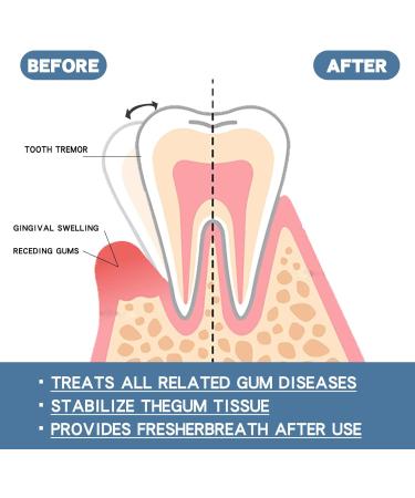 Uzionie Gum repair drops regenerating gel for gums for gum growth treatment for oral gum recession 30 ml - Buy Online on GoSupps.com