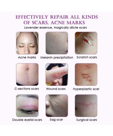 Allbesta Scar Repair Serum - Lavender Essence Essential Oil for Acne Burn & Stretch Marks Removal | Natural Skin Care 10ML - Buy Online on GoSupps.com