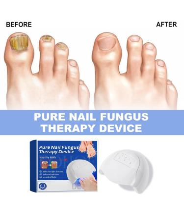 Furzero Nail Fungus Laser Treatment Device | Effective Laser Therapy for Nail Fungus - Buy Online on GoSupps.com