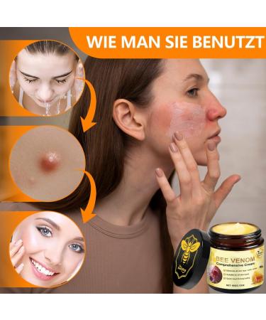 OIXYAZ Bee wart cream with bee venom Cream with bee venom Bee venom and turmeric for all skin types B - Buy Online on GoSupps.com