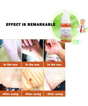 Mole Remover for the Body - 25g Blemish Correcting Liquid Solution | Mole Removal Solution - For Women At Home While Traveling Routine - Buy Online on GoSupps.com