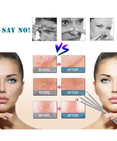 Ellolife 4-Pack Comedone Squeezer Set | Stainless Steel Blackhead Remover Kit for All Skin Types - Buy Online on GoSupps.com