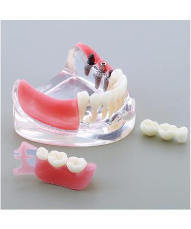 Dental Upper Implantate Model - Superior Overdenture Restoration for Education | Transparent Vision & Soft Gum - Ideal Study Tool - Buy Online on GoSupps.com