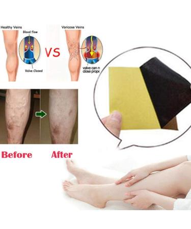 18Pcs Pat Varicose Veins Treatment Plasters Chinese Traditional Herbal Medicine Pads Cure Spider Veins Vasculitis