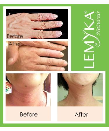Michaderm Eczema Cream - 10X Organic Plant Actives & Ceramides for Atopic Dermatitis - Fast Relief for Dry, Itchy Skin on Face, Eyelids, Hives - Suitable for Babies, Kids, and Adults - Buy Online on GoSupps.com