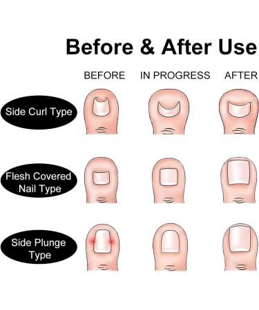 Corrective for Ingrown Nails Correction of Ingrown Nails Correction Kit 30 Pieces Correction Strips for Ingrown Nails Toe Nail Correction - Buy Online on GoSupps.com