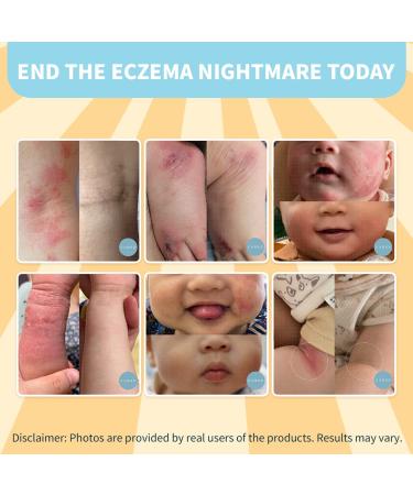 Cubed Eczema Body Butter for Kids with Honey and Oatmeal - Soothing Anti-Itch Cream for Dry, Irritated Skin - Helps Reduce Dark Spots - Healing Ointment for Eczema, Dermatitis, Psoriasis & Rosacea - Buy Online on GoSupps.com