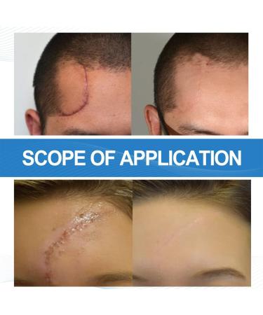Silicone Scar Remover Gel - Effective for Old & New Scars - 1.06 oz - 3PCS Set - Buy Online on GoSupps.com