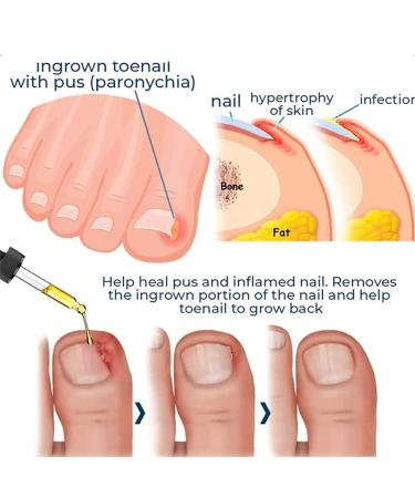 German Toenailplus & NailPro Anti Paronychia Relief Oil - Set of 2Pcs / 3Pcs - Buy Online on GoSupps.com