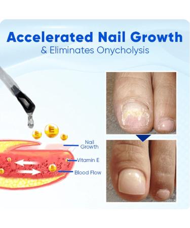 Onyxoguard Nail Growth And Repair Serum Onycholysisheal Nail Strengthening And Growth Conditioner Nail Growth And Strengthener Essence For Thin Nails And Growth (3PCS) - Buy Online on GoSupps.com