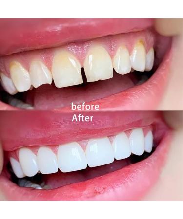Karjiaja Temporary Tooth Repair Set | Instant Dental Filling for Dentures & Veneers | 50g Tooth Granules & 50 Flaps | International Shipping Available - Buy Online on GoSupps.com