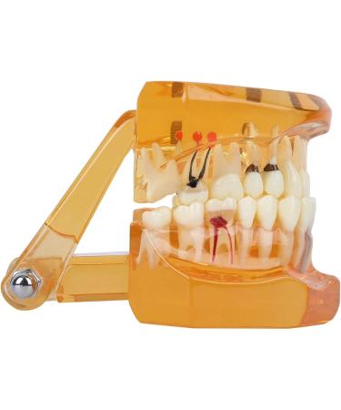 Dpofirs Orange Dental Model - Removable Teaching Tool for Dental Programs Adult Tooth Demonstration & Dental Implants - Buy Online on GoSupps.com