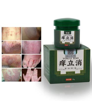 Eczema Cream with Natural Gentle Chinese Herbal Psoriasis Cream Anti Itch Cream for Dry and Irritated Skin - Dermatitis Shingles Acne Rosacea - Eczema Ointment (0.7 Ounce (Pack of 1))
