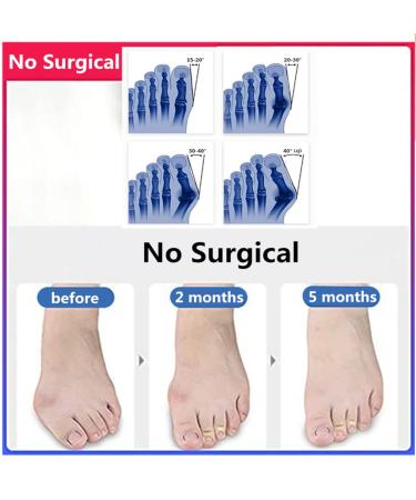 Orthopedic Big Toe Valgus Corrector for Pain Relief - Non-Surgical Bunion & Hammer Toe Straightener - Buy Online on GoSupps.com