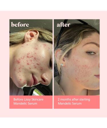 Lissy Skincare- Mandelic Acid + Niacinamide Serum For Breakouts Reduce Redness Blemish & Exfoliate Balancing Treatment | Licorice Root & Hyaluronic Acid Hydration & Improved Complexion - Buy Online on GoSupps.com